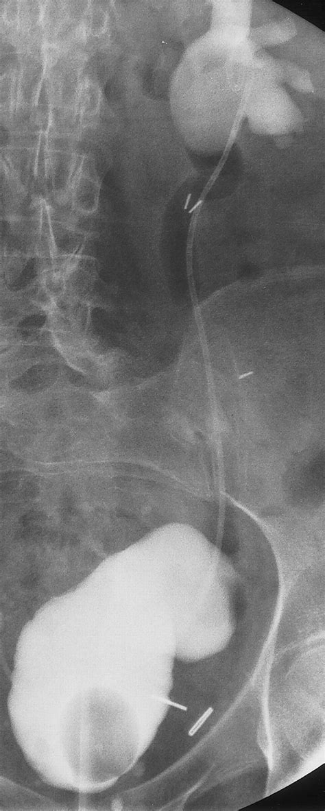 <b>Dislodged ureteral stent symptoms</b>. . Dislodged ureteral stent symptoms
